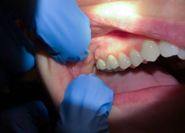 Best Knocked-Out Tooth Emergency  in Cedar Falls, IA